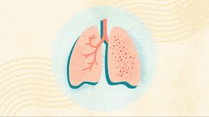 Training course  on Tuberculosis (TB) Diagnosis, Management, and Control